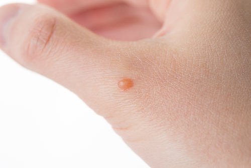 平井、亀戸、錦糸町、東あずま、いぼ、ぶつぶつ、ぼつぼつ、できもの、液体窒素