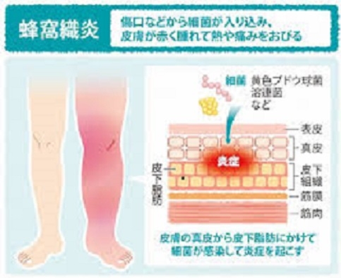 蜂窩織炎