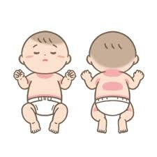 平井、亀戸、錦糸町、東あずま、夏、発疹、湿疹、赤み、かゆみ、あせも、汗疹