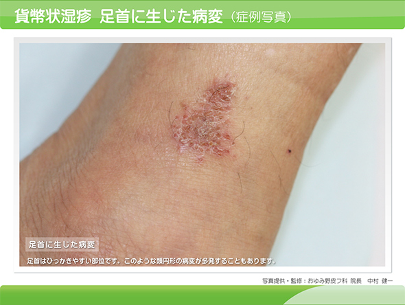 江戸川区平井の平井皮膚科クリニックで 湿疹やニキビ跡の治療