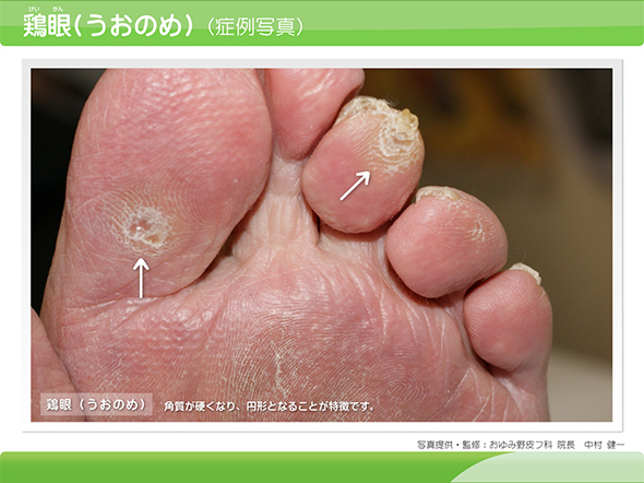 江戸川区平井の平井皮膚科クリニックで 湿疹やニキビ跡の治療