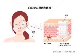 白斑