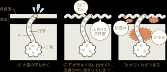 汗疱