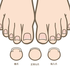 巻き爪