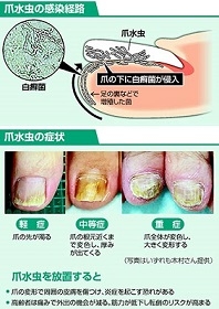 爪水虫